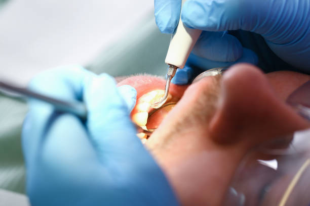 Best Emergency Dentist for Lost Fillings or Crowns in Newtown Grant, PA